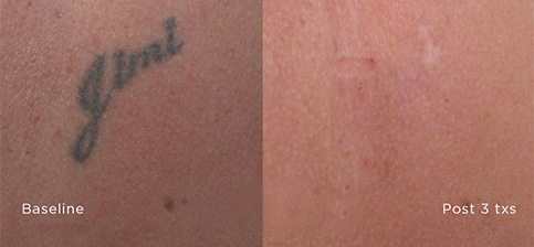 Tattoo Removal Seattle - Before and After