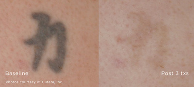 Federal Way Tattoo Removal Before and After